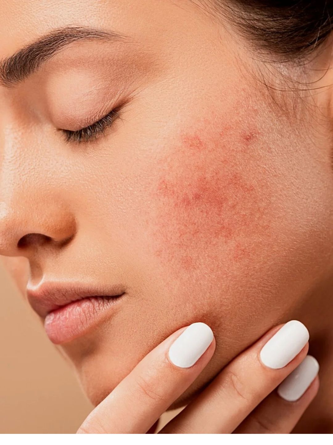 Cuidados Essenciais para Peles com Dermatite: 7 Passos para Alívio e Bem-Estar